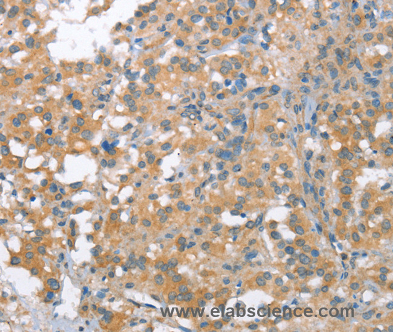 Immunohistochemistry of paraffin-embedded Human thyroid cancer tissue using NLRP7 Polyclonal Antibody at dilution 1:40