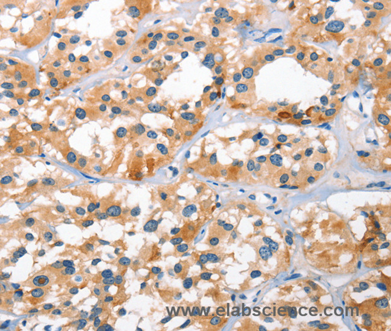 Immunohistochemistry of paraffin-embedded Human thyroid cancer tissue using BNIP3L Polyclonal Antibody at dilution 1:40