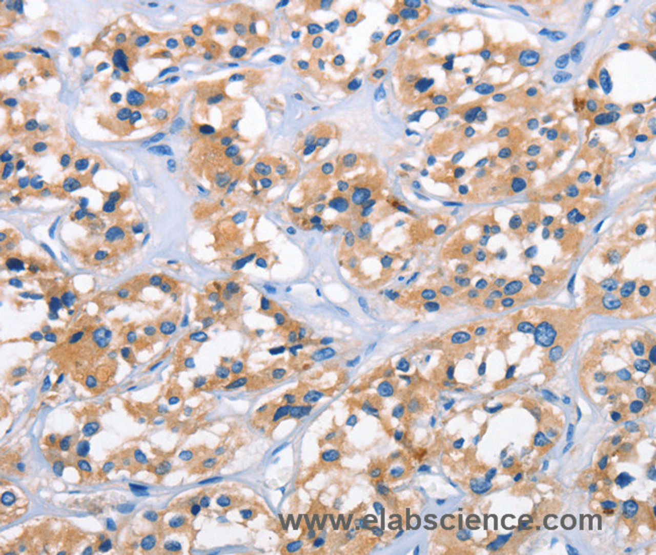 Immunohistochemistry of paraffin-embedded Human thyroid cancer tissue using APOL6 Polyclonal Antibody at dilution 1:50