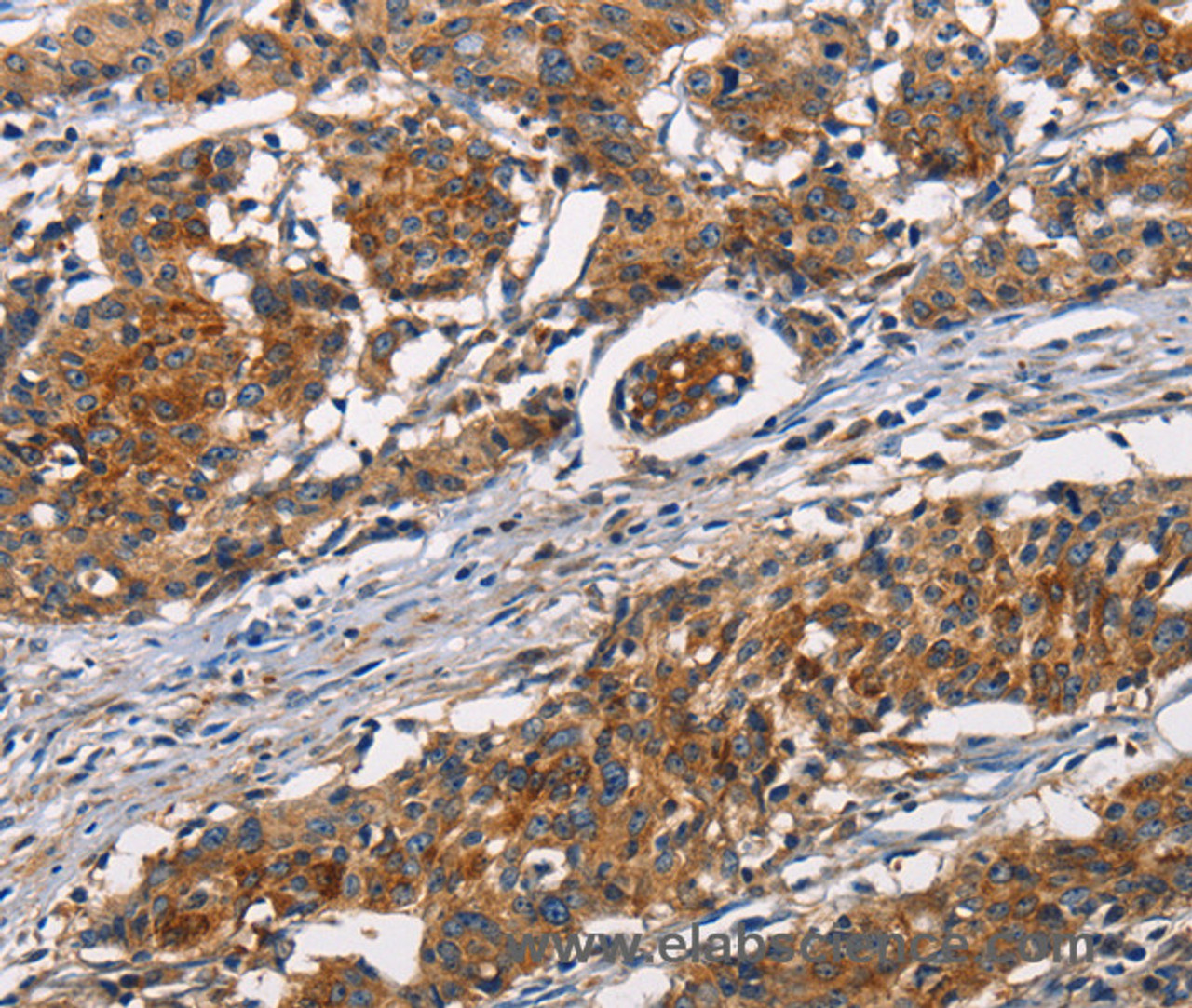 Immunohistochemistry of paraffin-embedded Human gastic cancer using ATP7A  Polyclonal Antibody at dilution of 1:50