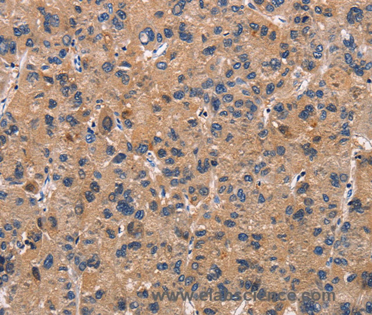 Immunohistochemistry of paraffin-embedded Human liver cancer using ATP7A  Polyclonal Antibody at dilution of 1:50