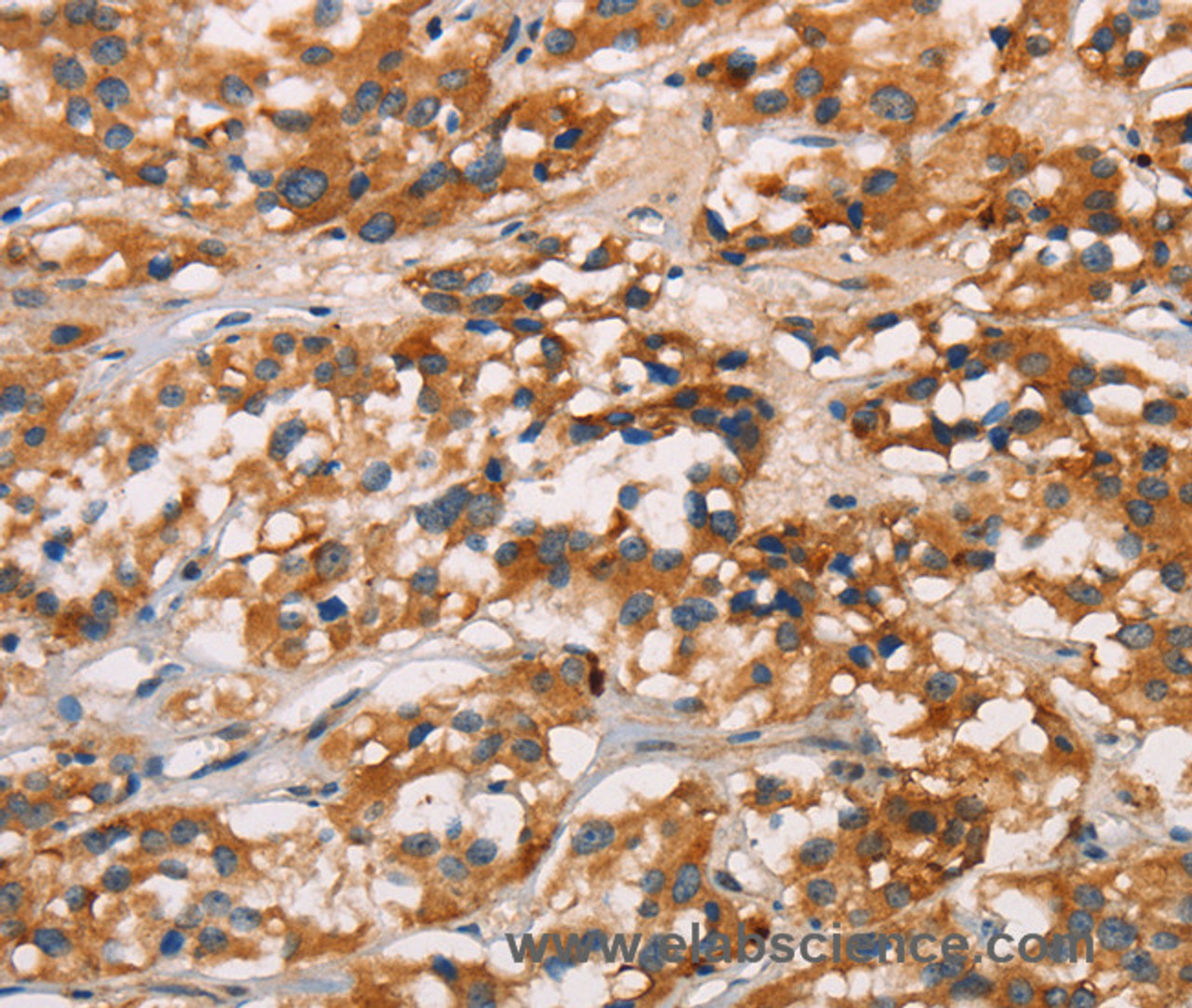 Immunohistochemistry of paraffin-embedded Human thyroid cancer tissue using CD80 Polyclonal Antibody at dilution 1:50