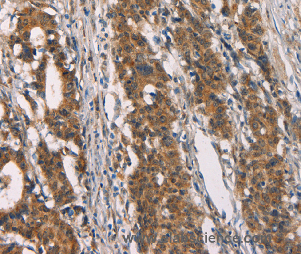 Immunohistochemistry of paraffin-embedded Human gastric cancer tissue using CD80 Polyclonal Antibody at dilution 1:50