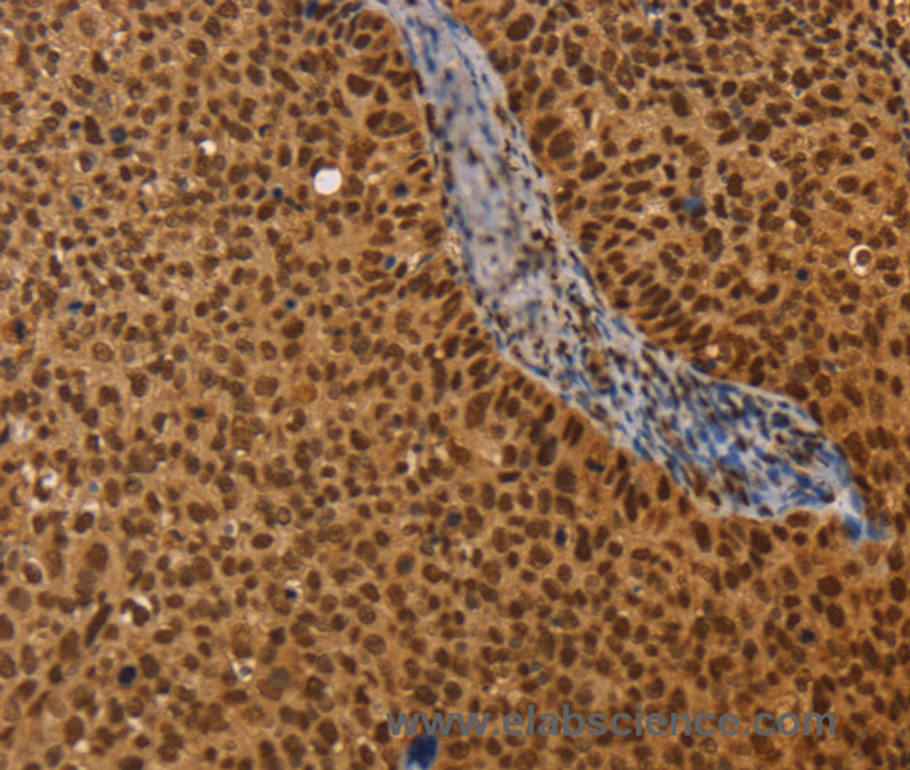 Immunohistochemistry of paraffin-embedded Human cervical cancer using CEL Polyclonal Antibody at dilution of 1:40