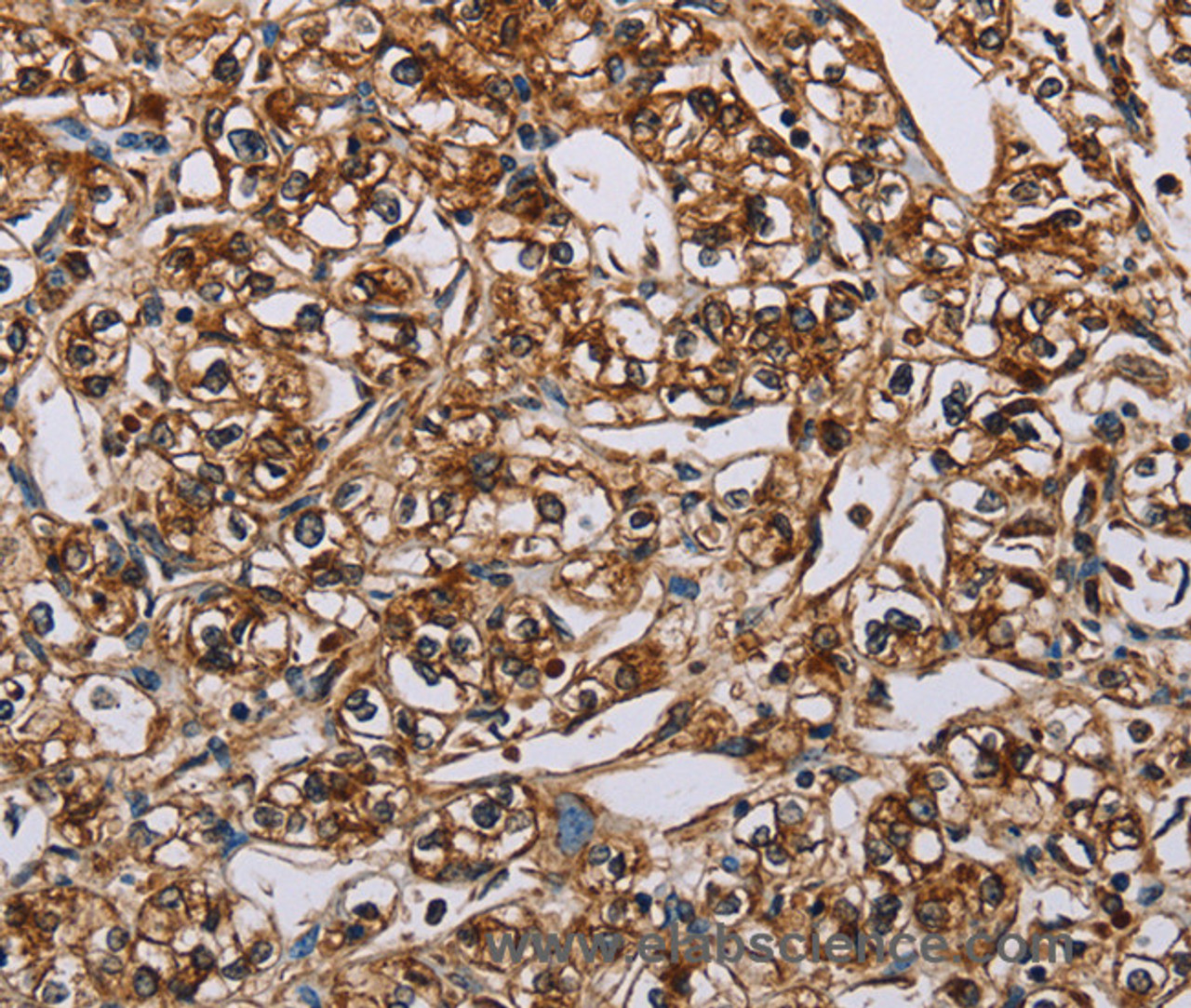 Immunohistochemistry of paraffin-embedded Human prostate cancer using BMP6 Polyclonal Antibody at dilution of 1:50