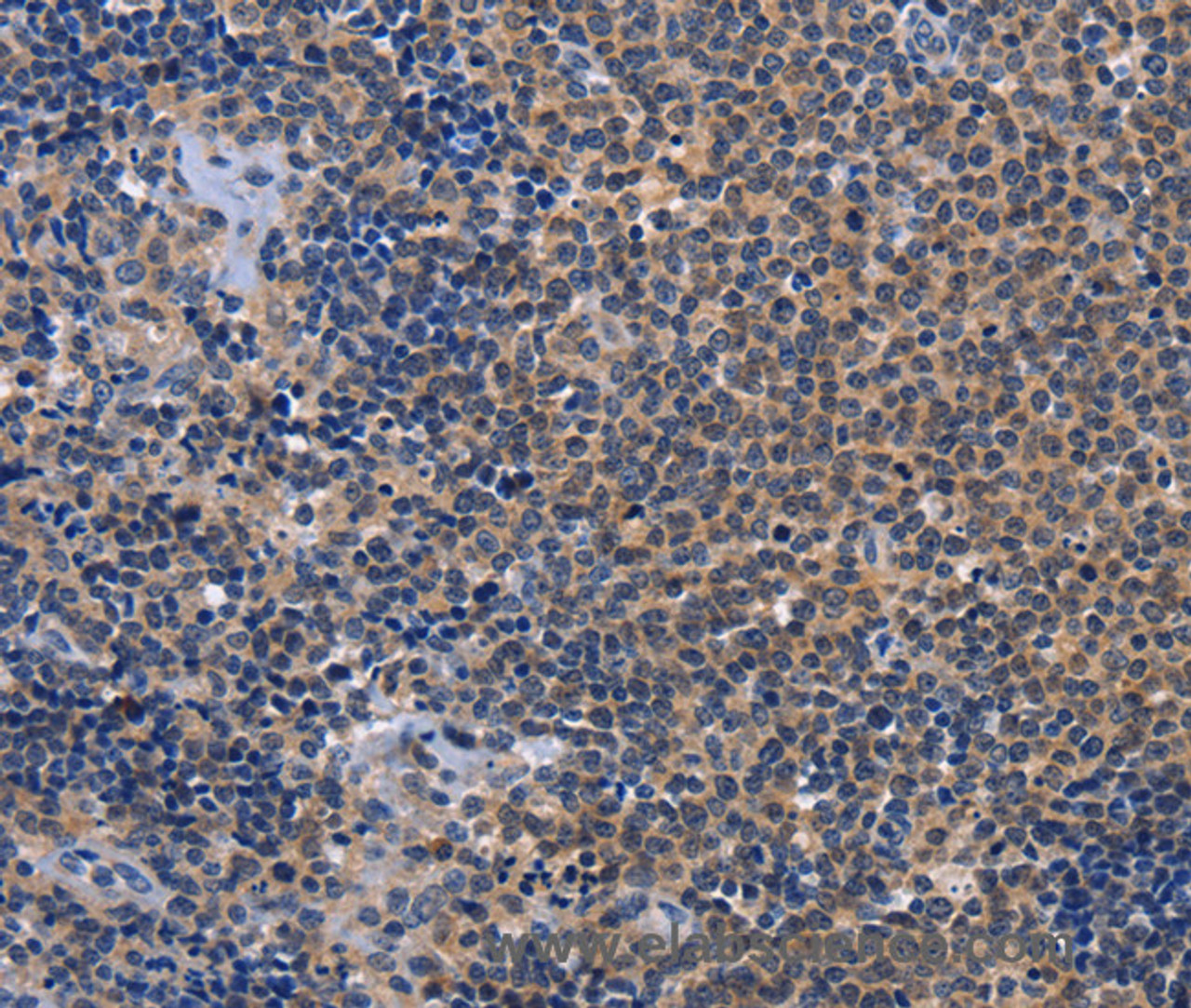 Immunohistochemistry of paraffin-embedded Human Lymphoma tissue using GDF11 Polyclonal Antibody at dilution 1:30