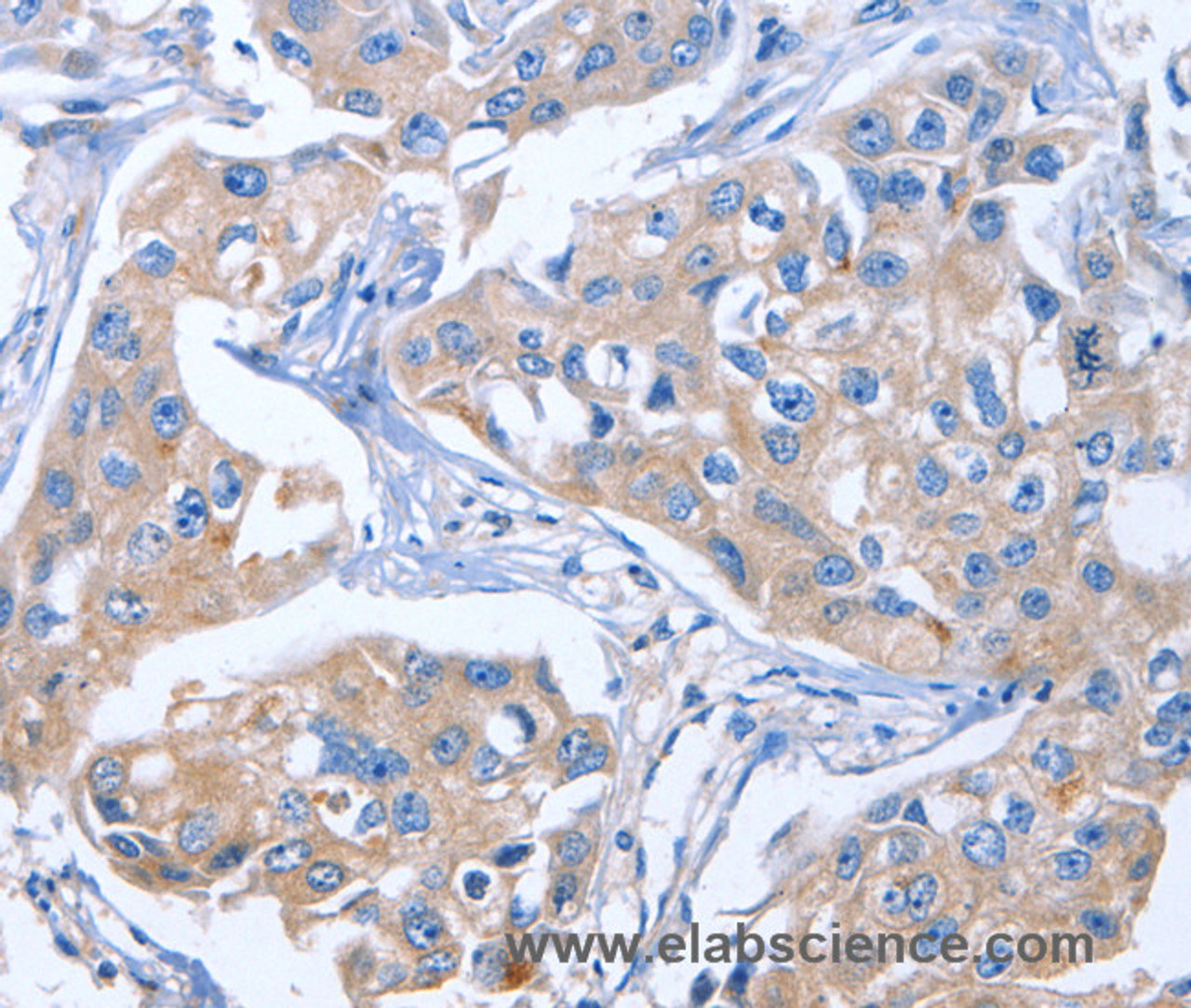 Immunohistochemistry of paraffin-embedded Human breast cancer tissue using IBSP Polyclonal Antibody at dilution of 1:50