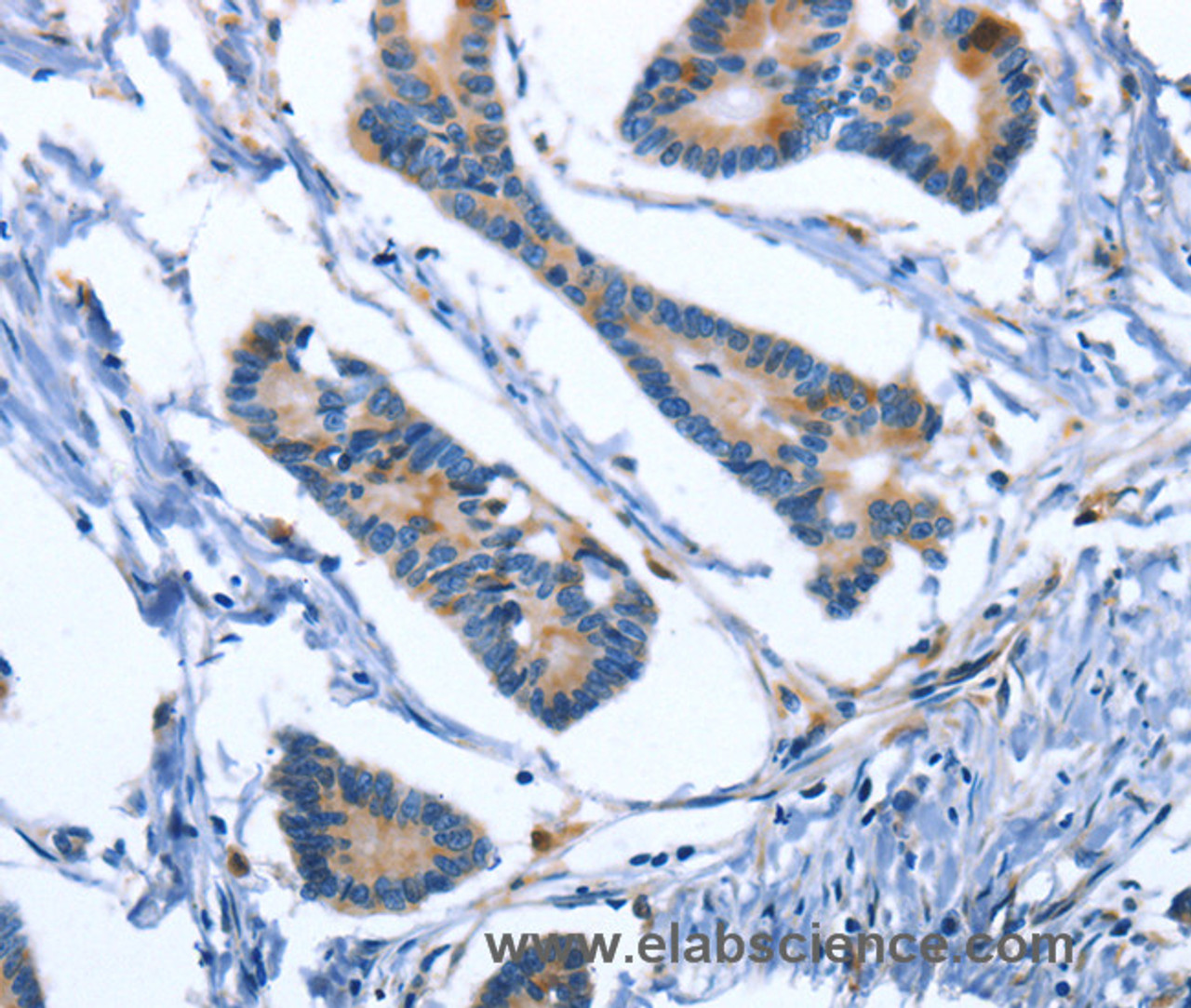 Immunohistochemistry of paraffin-embedded Human colon cancer using IBSP Polyclonal Antibody at dilution of 1:50