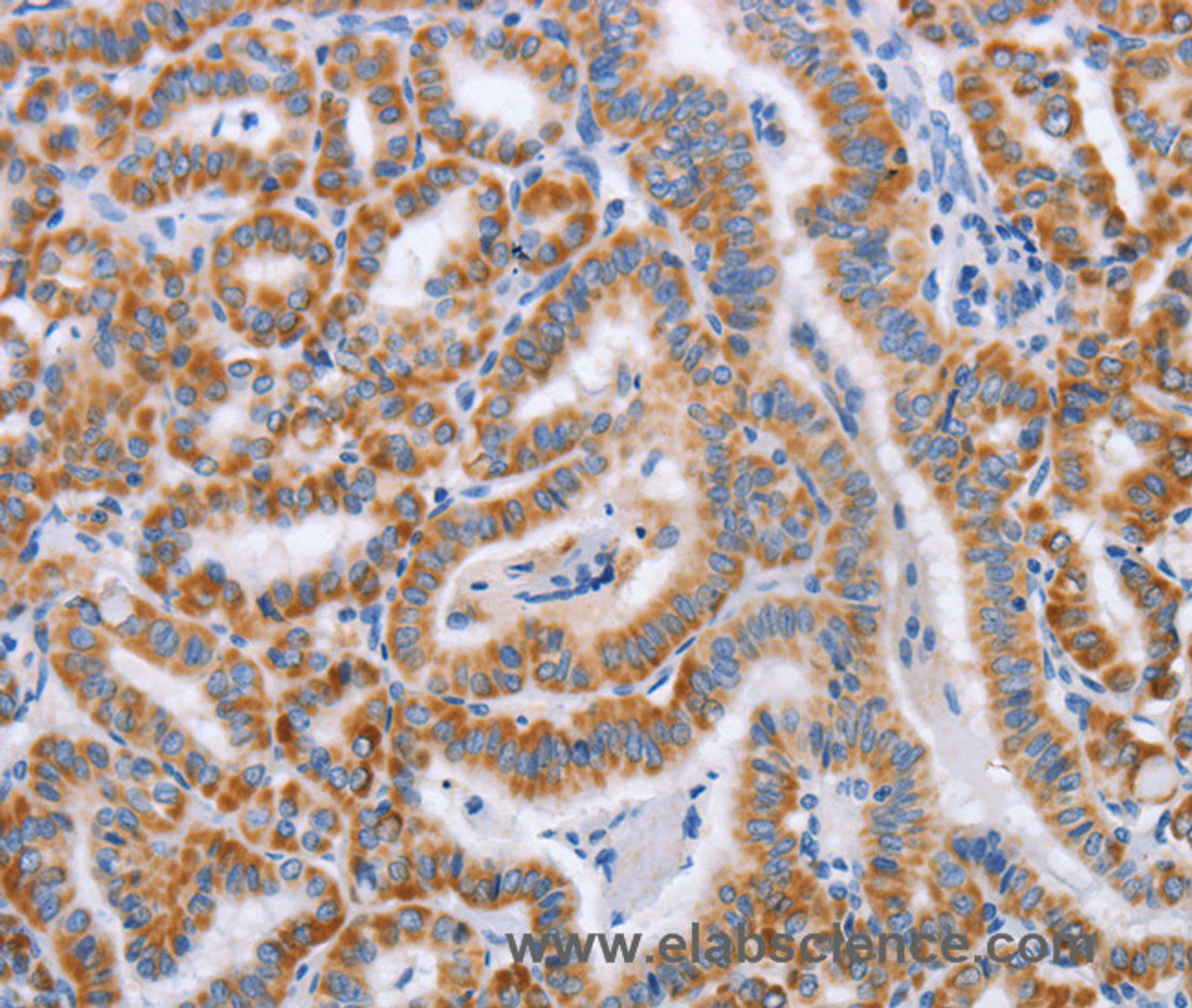 Immunohistochemistry of paraffin-embedded Human thyroid cancer tissue using BST1 Polyclonal Antibody at dilution 1:50
