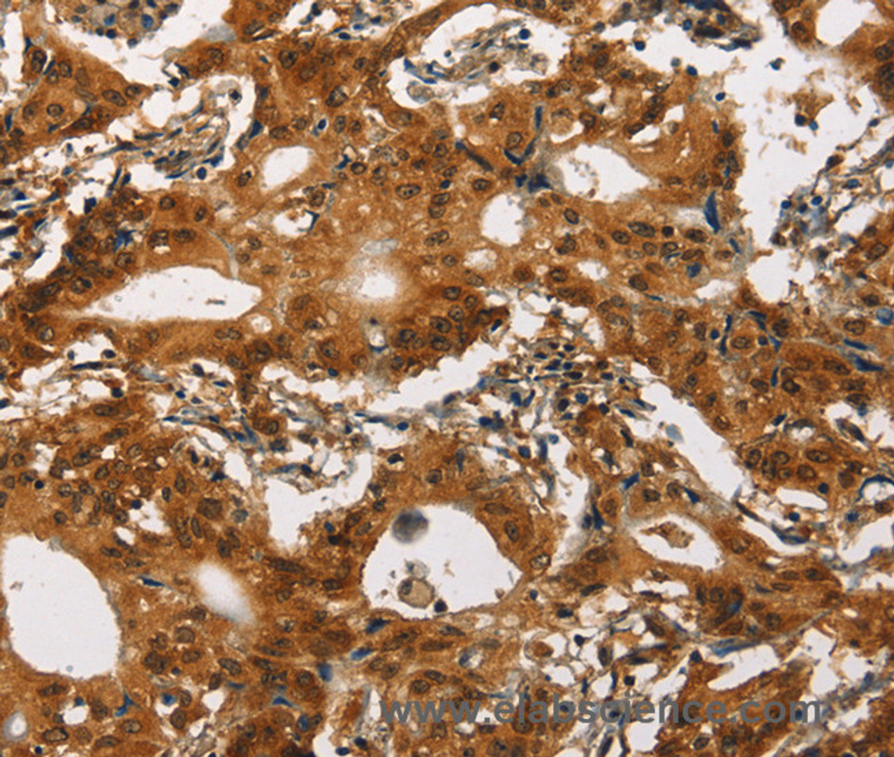 Immunohistochemistry of paraffin-embedded Human gasrtic cancer tissue using Cav1.2 Polyclonal Antibody at dilution 1:30