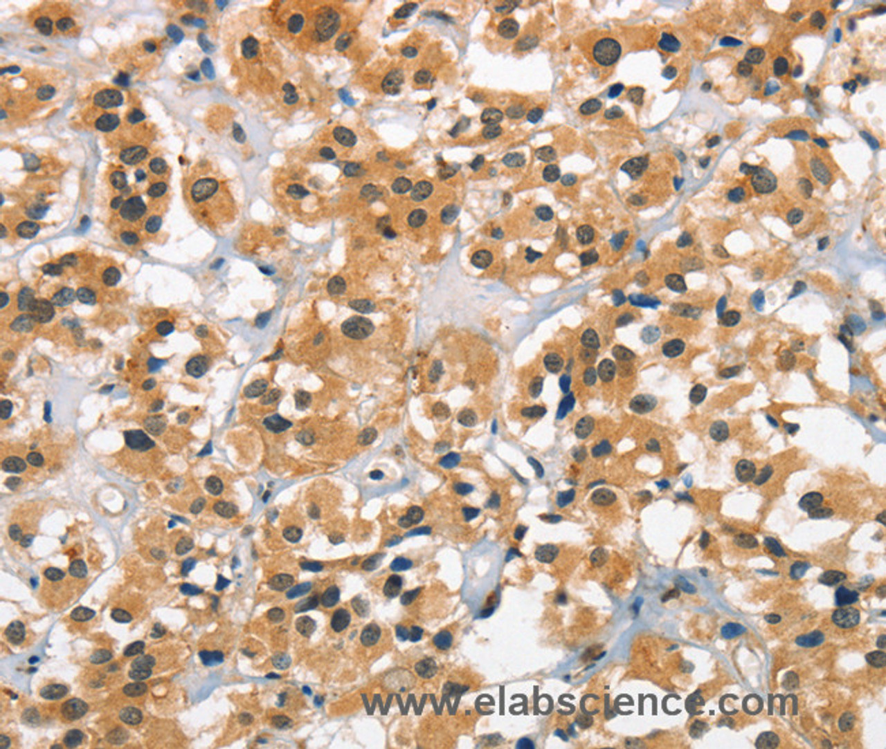 Immunohistochemistry of paraffin-embedded Human thyroid cancer tissue using Cav1.2 Polyclonal Antibody at dilution 1:30