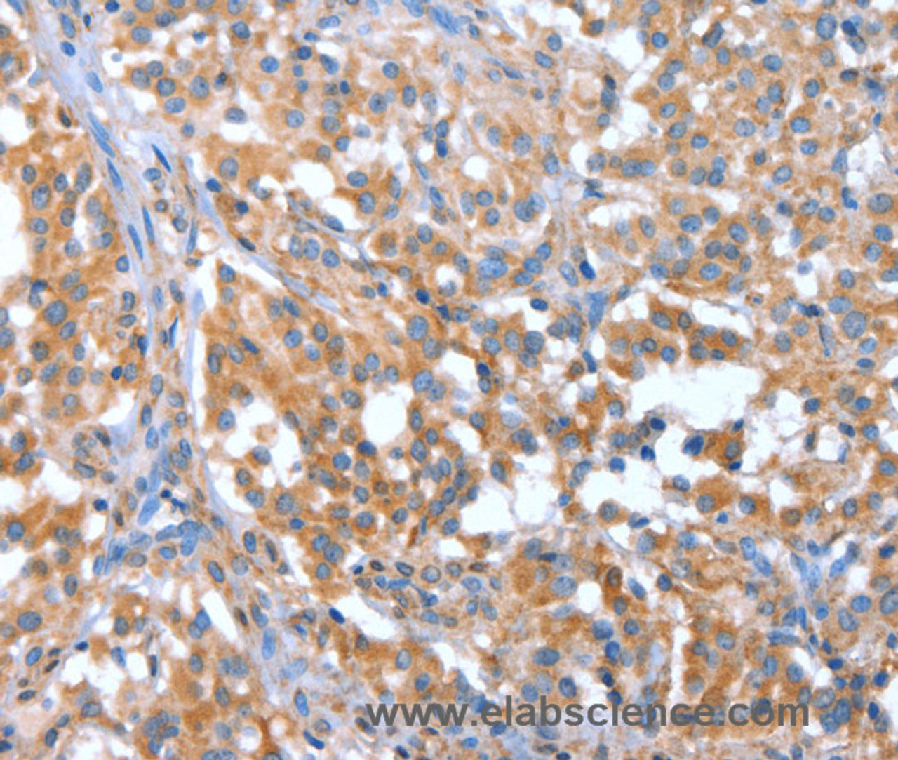 Immunohistochemistry of paraffin-embedded Human thyroid cancer tissue using NOD2 Polyclonal Antibody at dilution 1:40