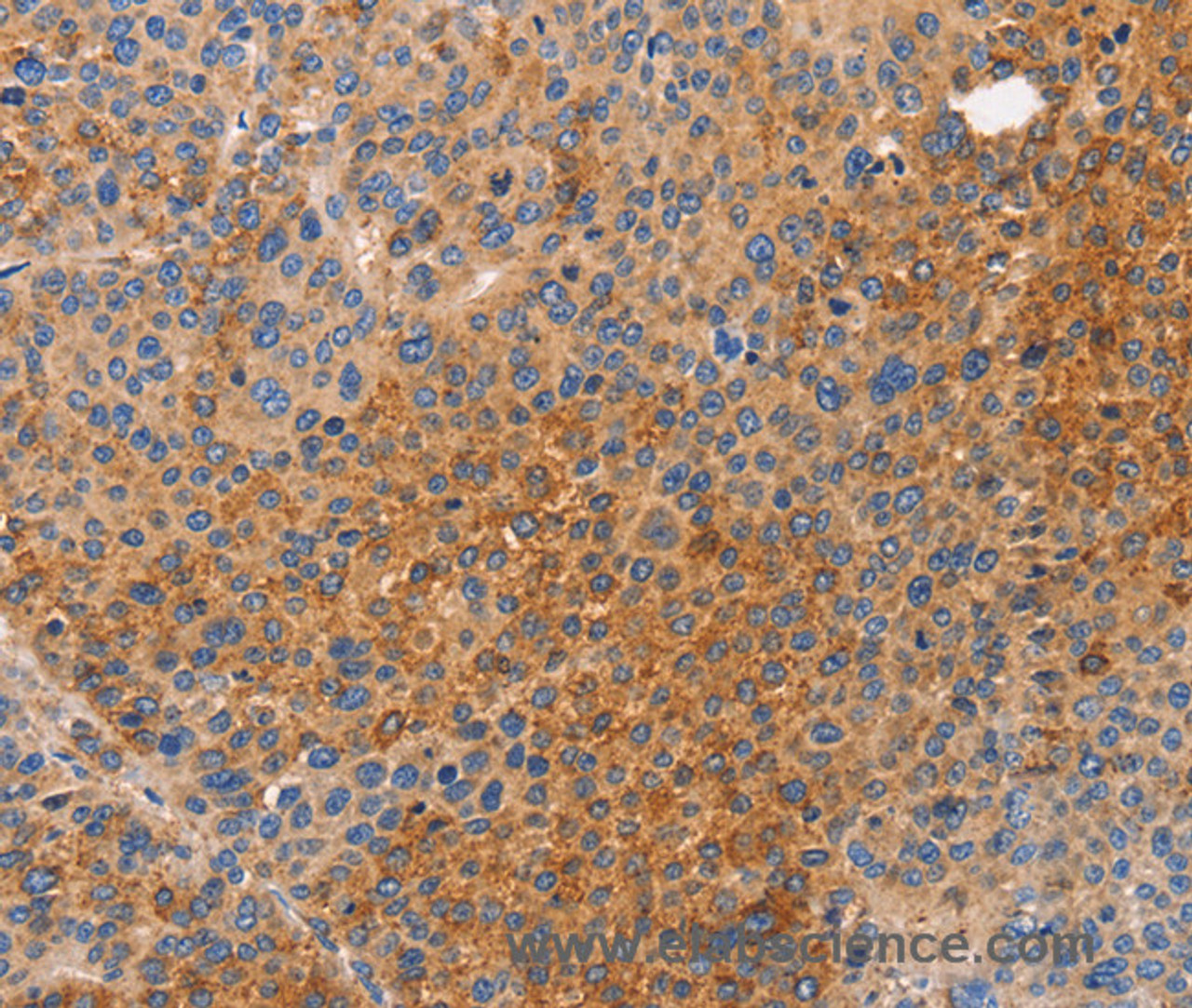 Immunohistochemistry of paraffin-embedded Human liver cancer tissue using NOD1 Polyclonal Antibody at dilution 1:50