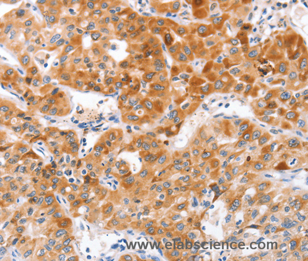 Immunohistochemistry of paraffin-embedded Human lung cancer tissue using NOD1 Polyclonal Antibody at dilution 1:50