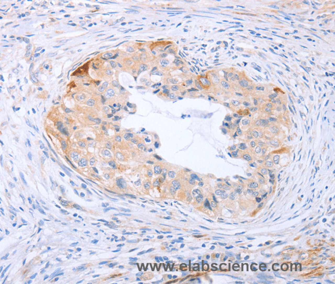 Immunohistochemistry of paraffin-embedded Human cervical cancer tissue using CARD6 Polyclonal Antibody at dilution 1:60