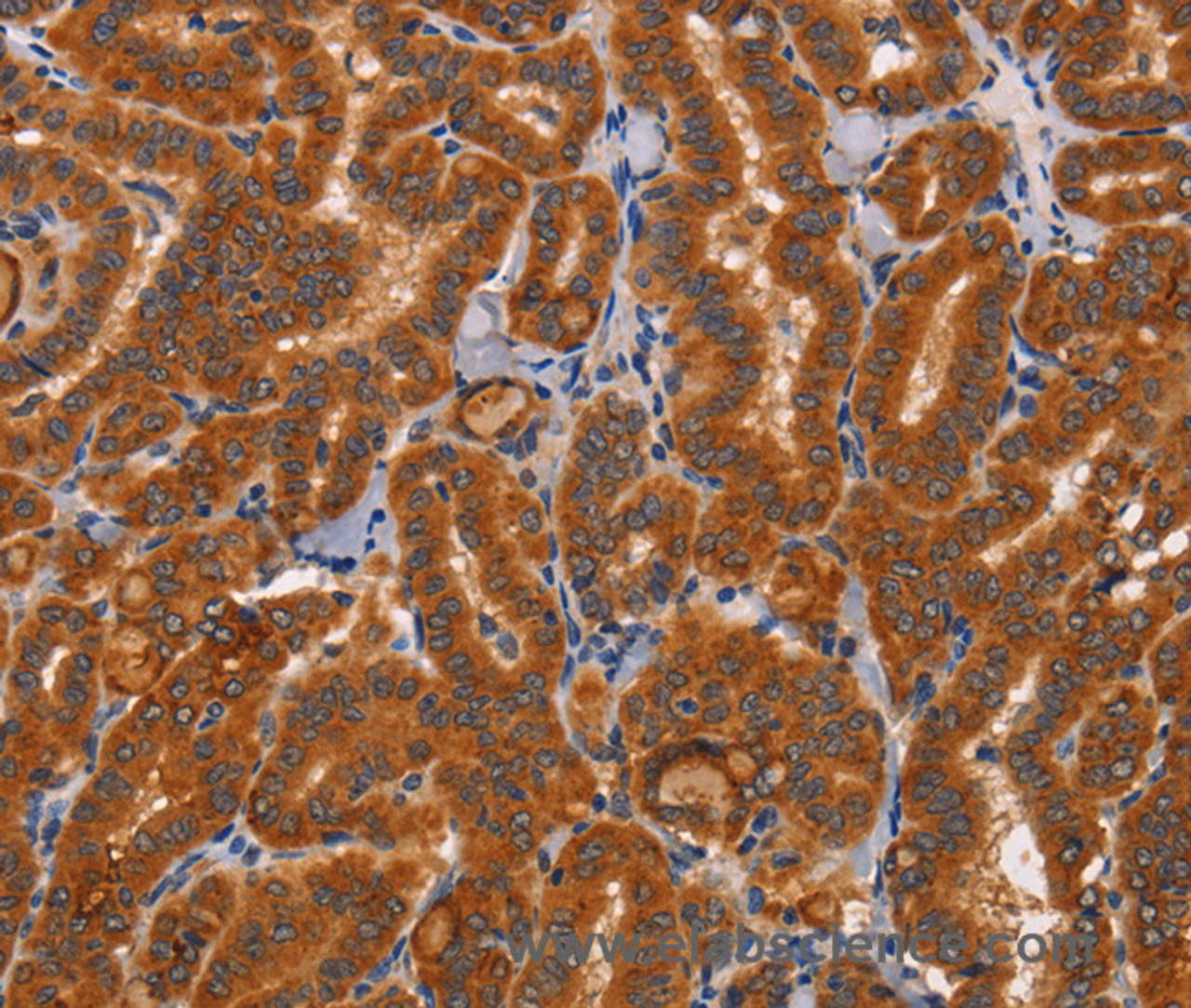 Immunohistochemistry of paraffin-embedded Human thyroid cancer using CTSC Polyclonal Antibody at dilution of 1:50