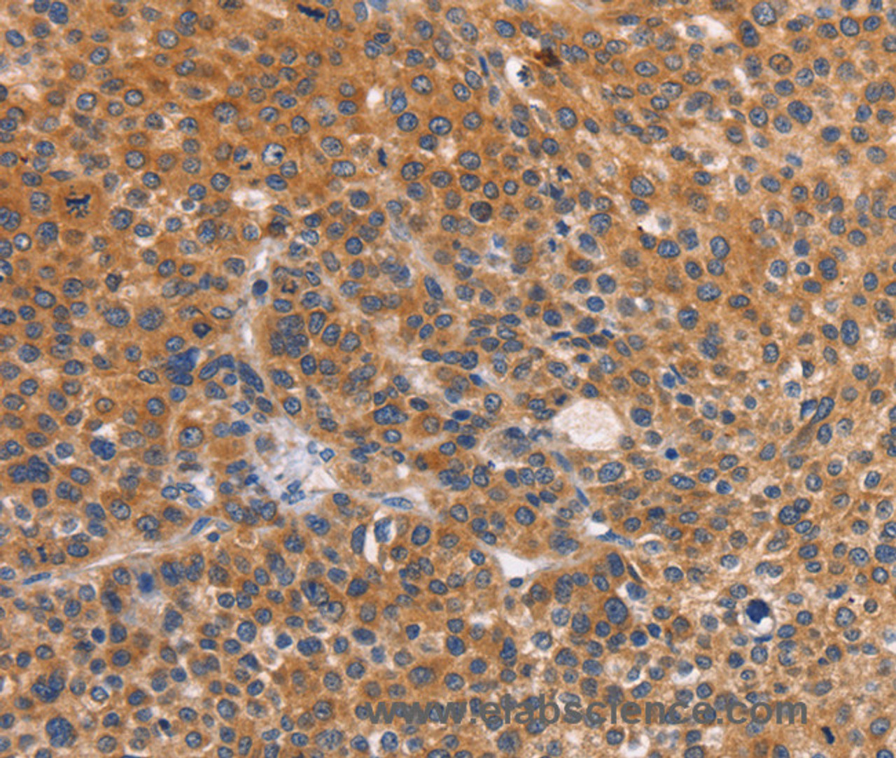 Immunohistochemistry of paraffin-embedded Human liver cancer using CTSC Polyclonal Antibody at dilution of 1:50