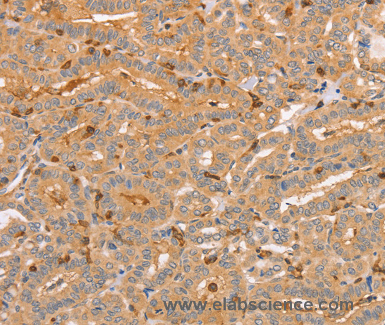 Immunohistochemistry of paraffin-embedded Human thyroid cancer tissue using CCL16  Polyclonal Antibody at dilution 1:60