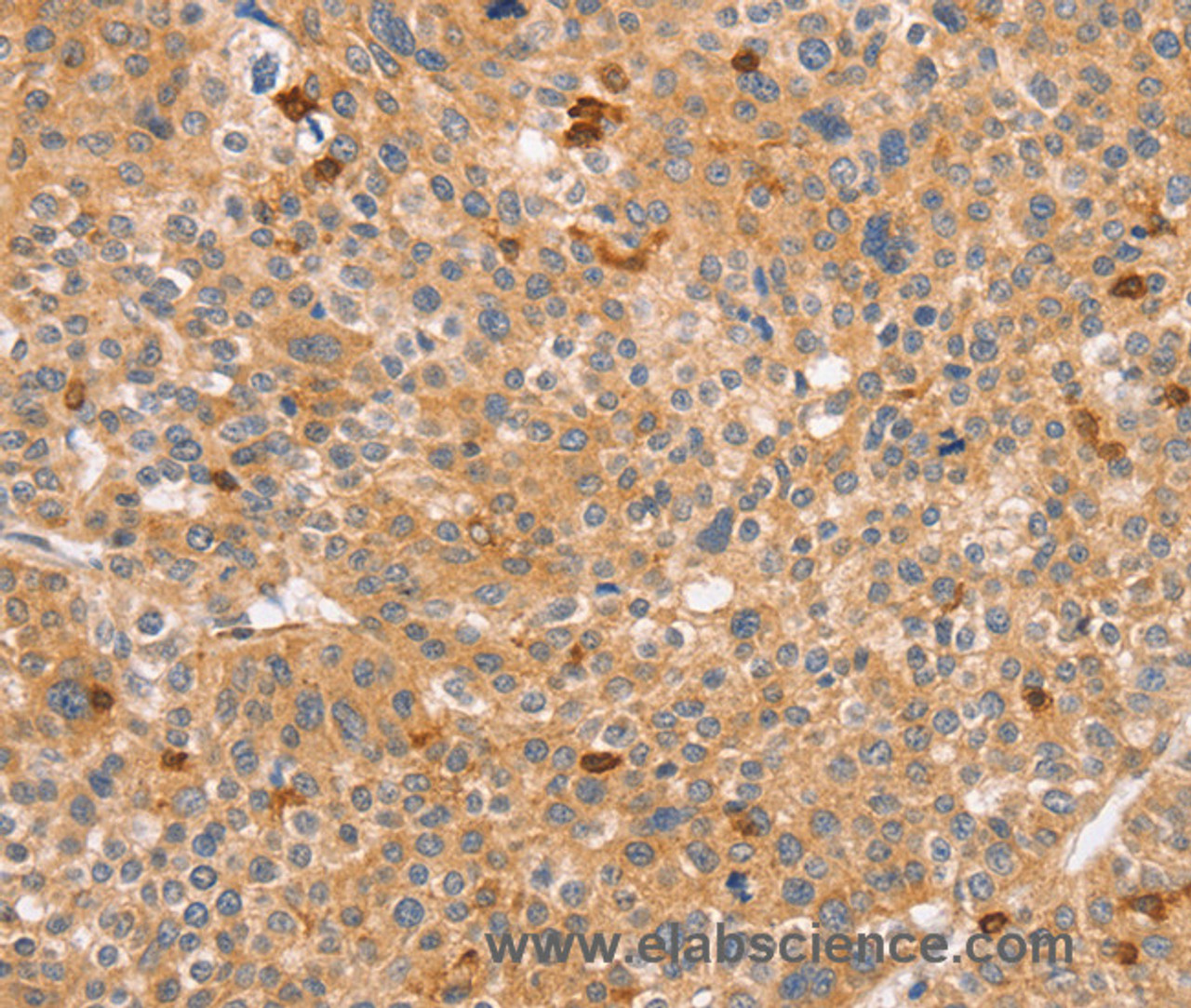 Immunohistochemistry of paraffin-embedded Human liver cancer tissue using CCL16  Polyclonal Antibody at dilution 1:60