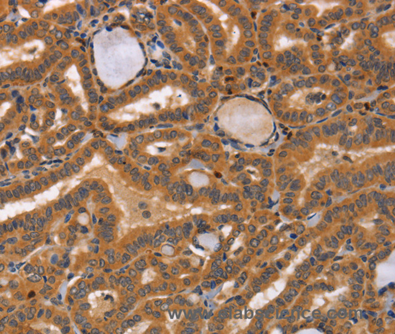 Immunohistochemistry of paraffin-embedded Human thyroid cancer tissue using CCL23 Polyclonal Antibody at dilution 1:50