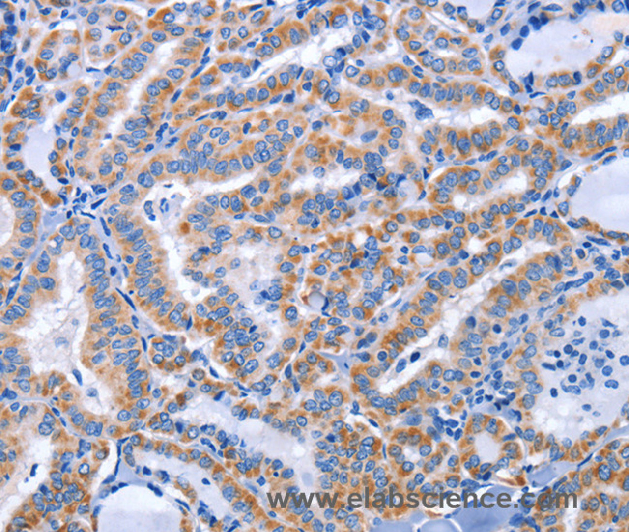 Immunohistochemistry of paraffin-embedded Human thyroid cancer using CCR6 Polyclonal Antibody at dilution of 1:50