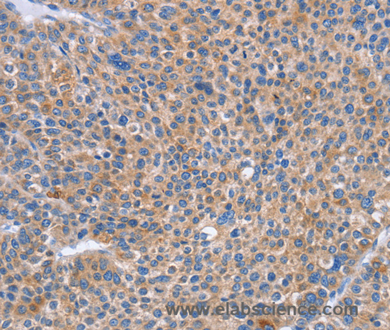 Immunohistochemistry of paraffin-embedded Human liver cancer using CD328 Polyclonal Antibody at dilution of 1:50