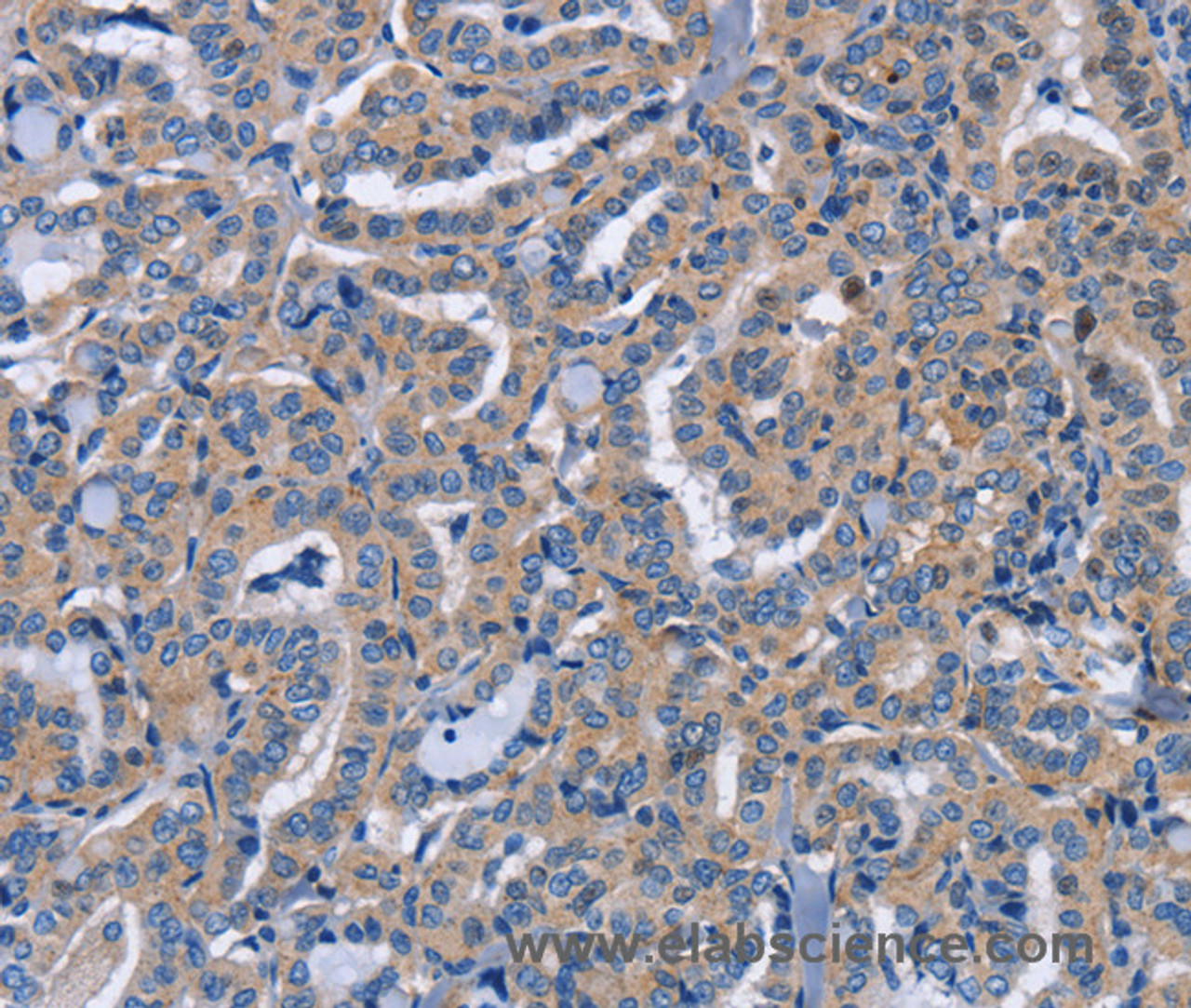 Immunohistochemistry of paraffin-embedded Human thyroid cancer tissue using NCR2 Polyclonal Antibody at dilution 1:60