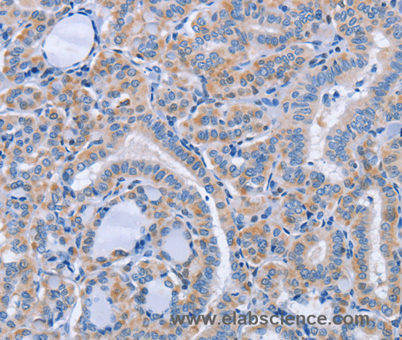 Immunohistochemistry of paraffin-embedded Human thyroid cancer using CD36 Polyclonal Antibody at dilution of 1:60