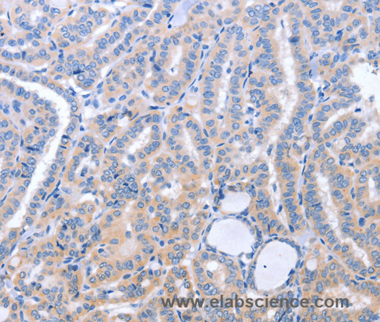 Immunohistochemistry of paraffin-embedded Human thyroid cancer using B3GAT1 Polyclonal Antibody at dilution of 1:40