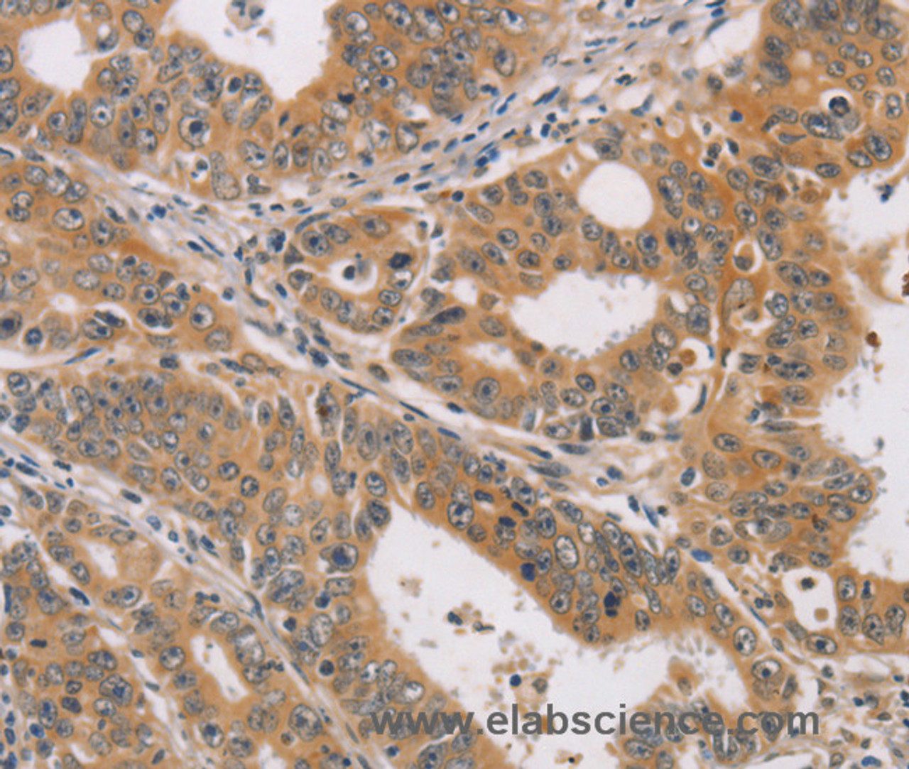 Immunohistochemistry of paraffin-embedded Human gastric cancer using CDK11B Polyclonal Antibody at dilution of 1:40