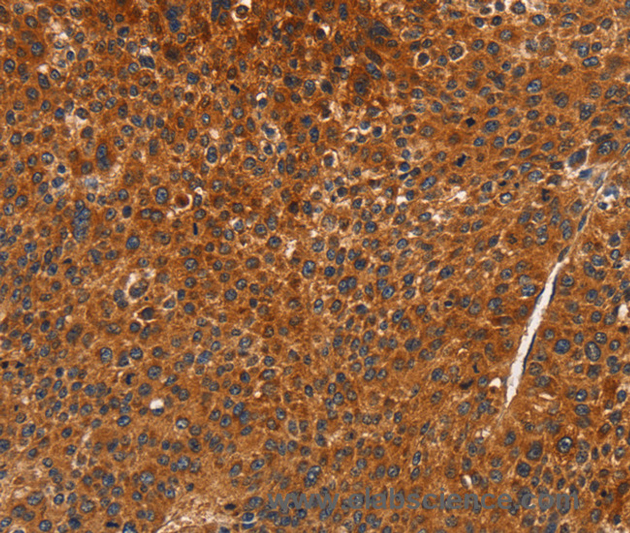 Immunohistochemistry of paraffin-embedded Human liver cancer using CDK19 Polyclonal Antibody at dilution of 1:70