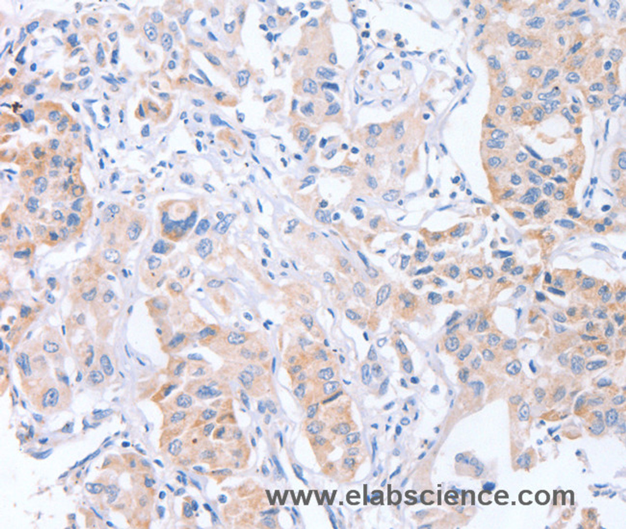 Immunohistochemistry of paraffin-embedded Human lung cancer tissue using CDCA4 Polyclonal Antibody at dilution 1:50
