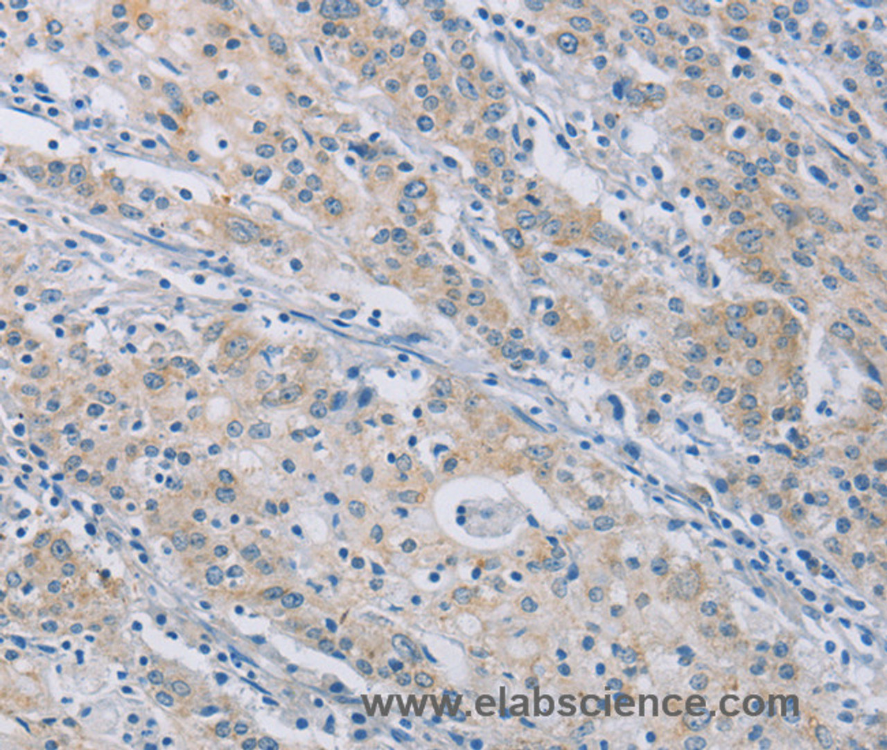 Immunohistochemistry of paraffin-embedded Human gastric cancer tissue using CERKL Polyclonal Antibody at dilution 1:50