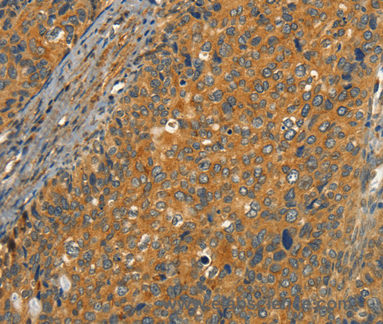 Immunohistochemistry of paraffin-embedded Human cervical cancer tissue using CIB1 Polyclonal Antibody at dilution 1:30
