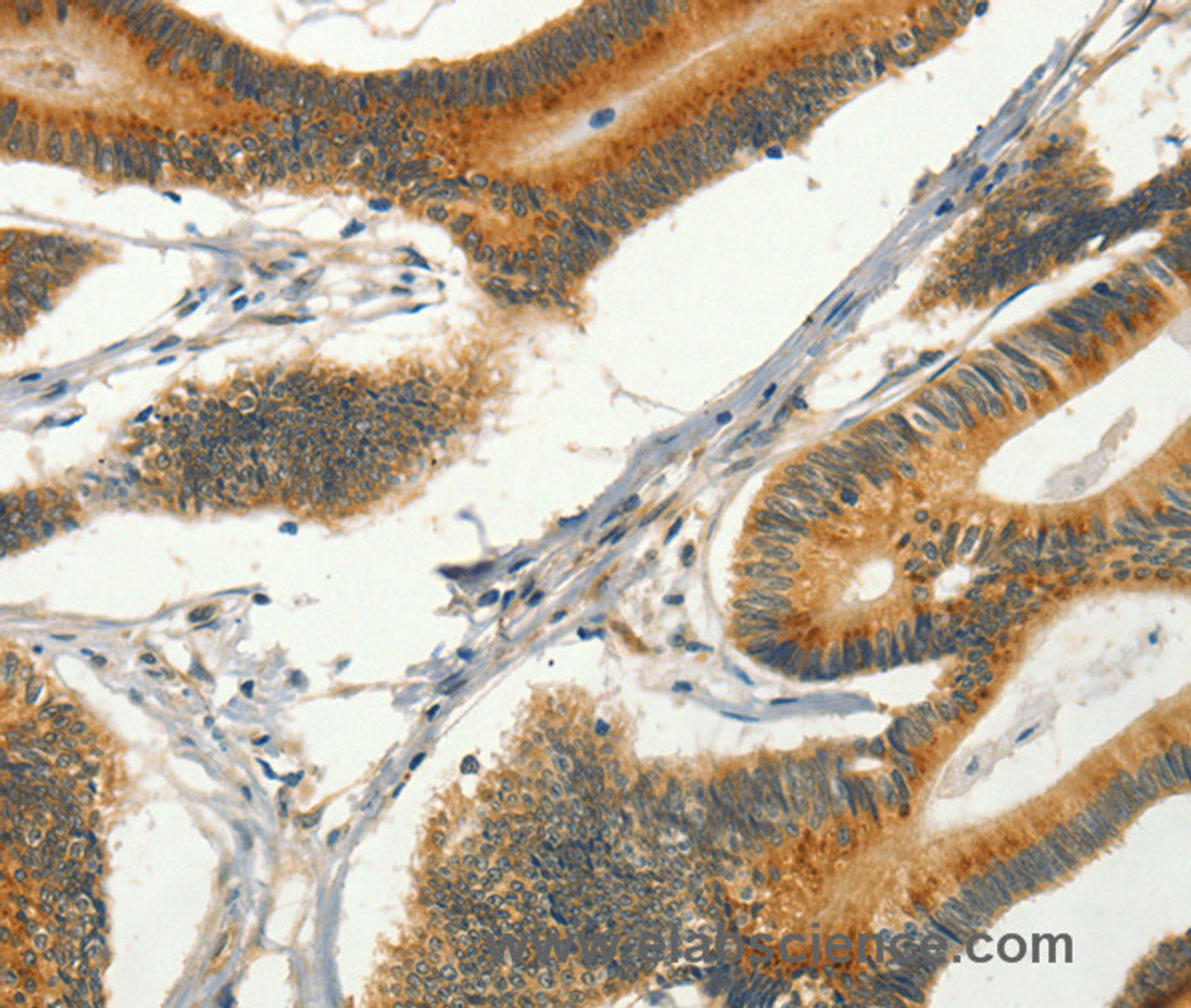 Immunohistochemistry of paraffin-embedded Human colon cancer tissue using CIB1 Polyclonal Antibody at dilution 1:30