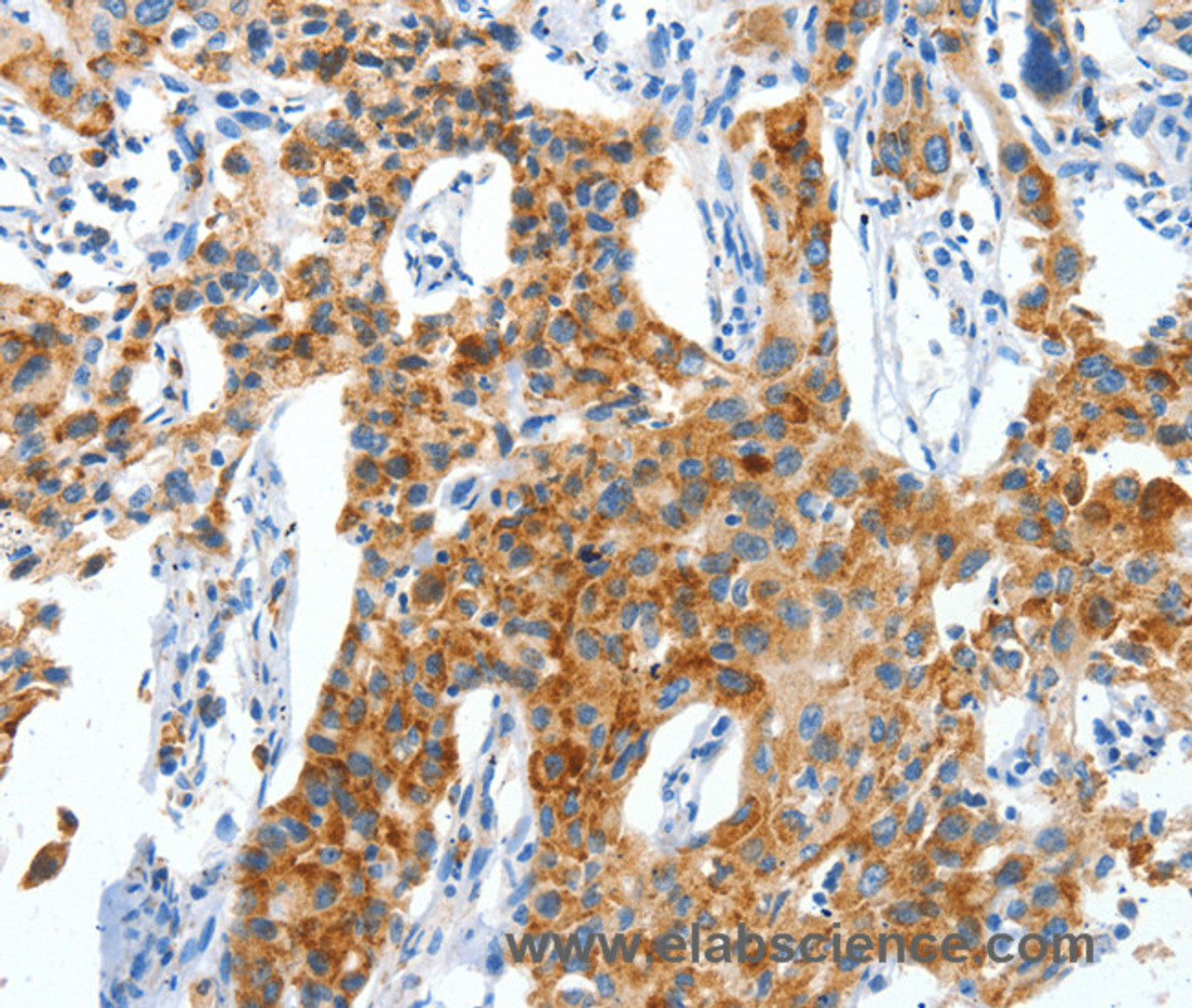 Immunohistochemistry of paraffin-embedded Human lung cancer using CKAP4 Polyclonal Antibody at dilution of 1:50