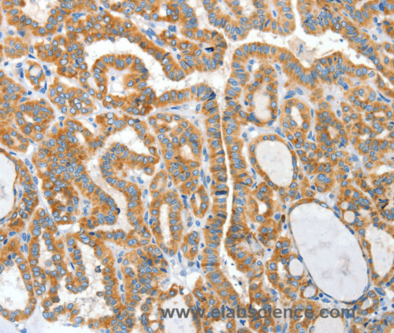 Immunohistochemistry of paraffin-embedded Human thyroid cancer using CKAP4 Polyclonal Antibody at dilution of 1:50