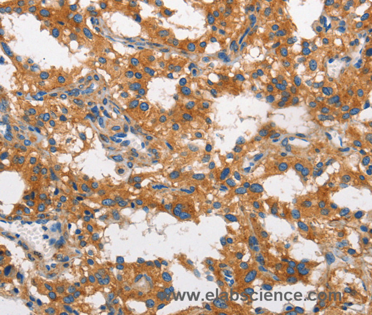 Immunohistochemistry of paraffin-embedded Human thyroid cancer using CLTC Polyclonal Antibody at dilution of 1:60