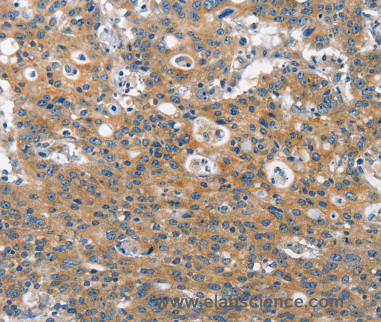 Immunohistochemistry of paraffin-embedded Human gastric cancer using CLTC Polyclonal Antibody at dilution of 1:60