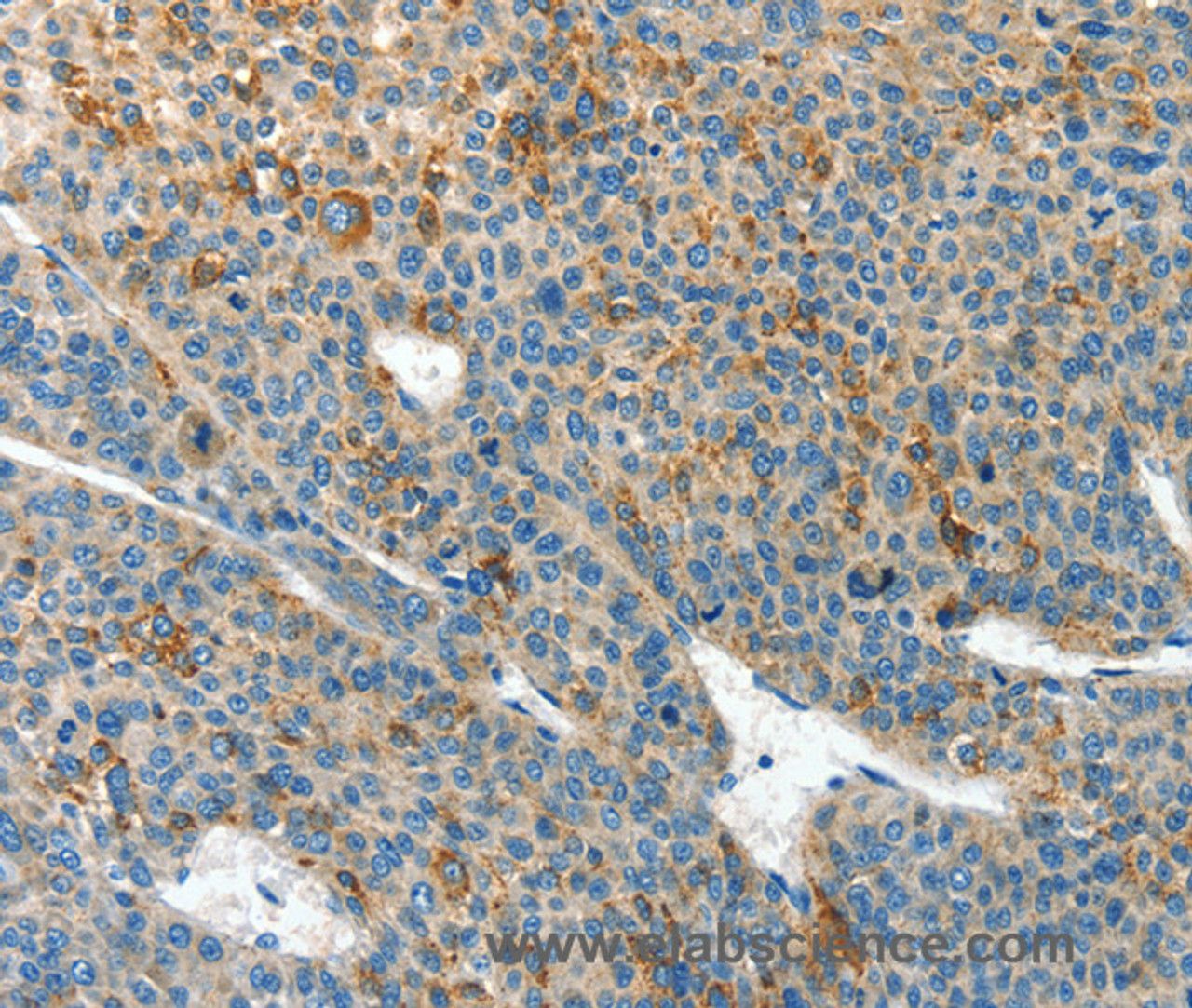 Immunohistochemistry of paraffin-embedded Human liver cancer tissue using CLPTM1L Polyclonal Antibody at dilution 1:60