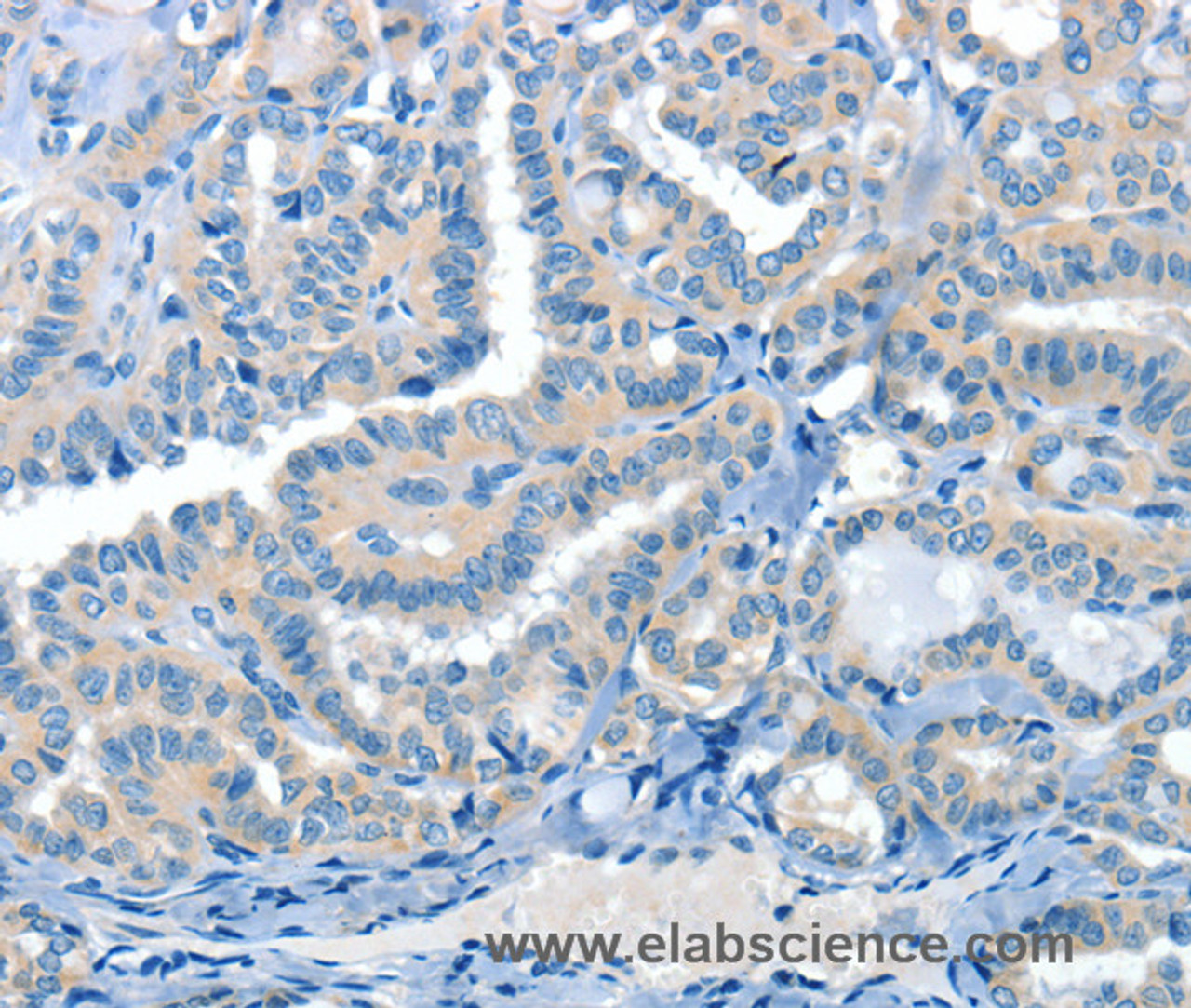 Immunohistochemistry of paraffin-embedded Human thyroid cancer tissue using CRLF2 Polyclonal Antibody at dilution 1:60