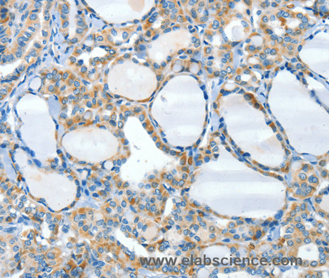 Immunohistochemistry of paraffin-embedded Human thyroid cancer tissue using HID1 Polyclonal Antibody at dilution 1:50