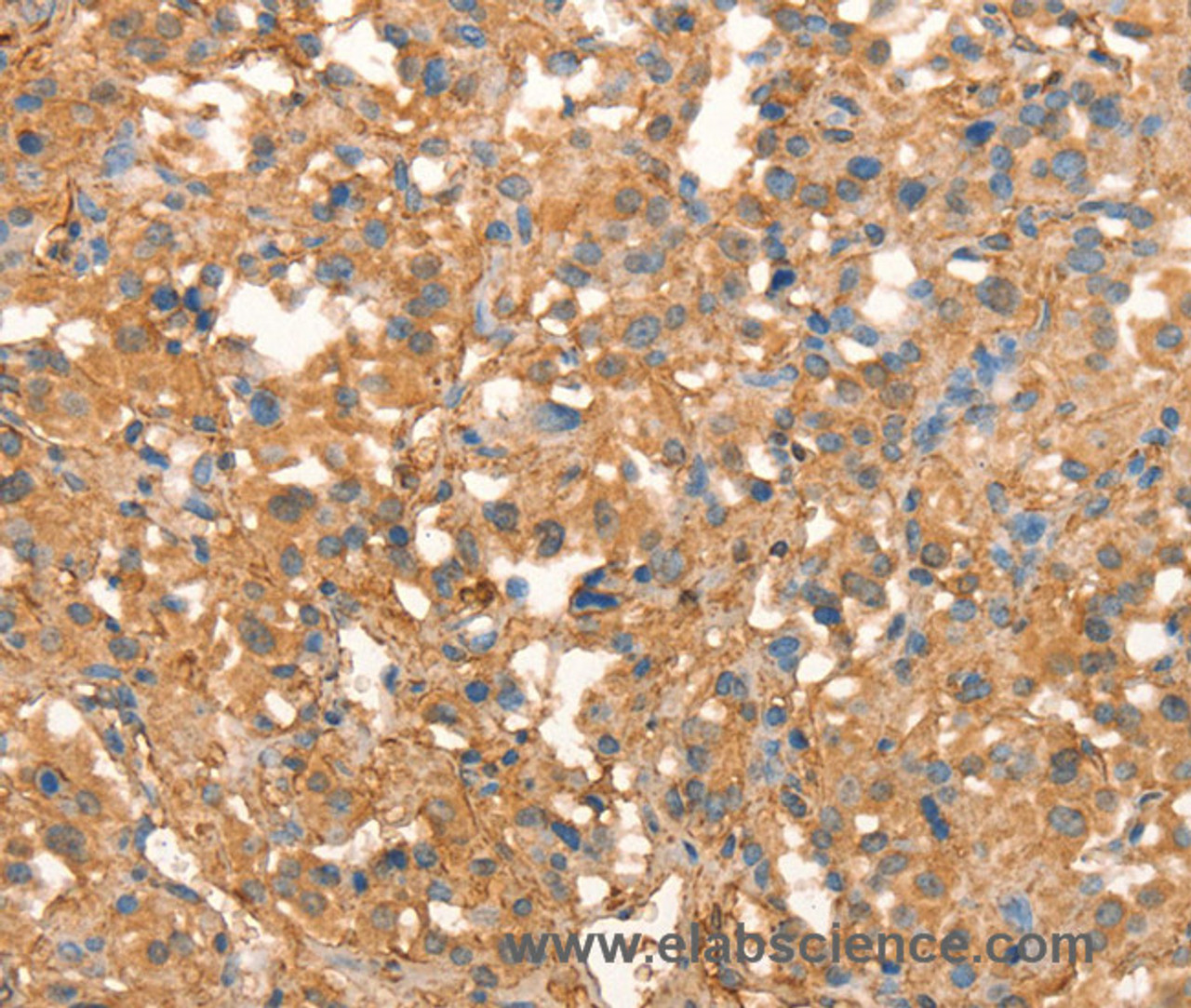 Immunohistochemistry of paraffin-embedded Human thyroid cancer using CRELD1 Polyclonal Antibody at dilution of 1:40