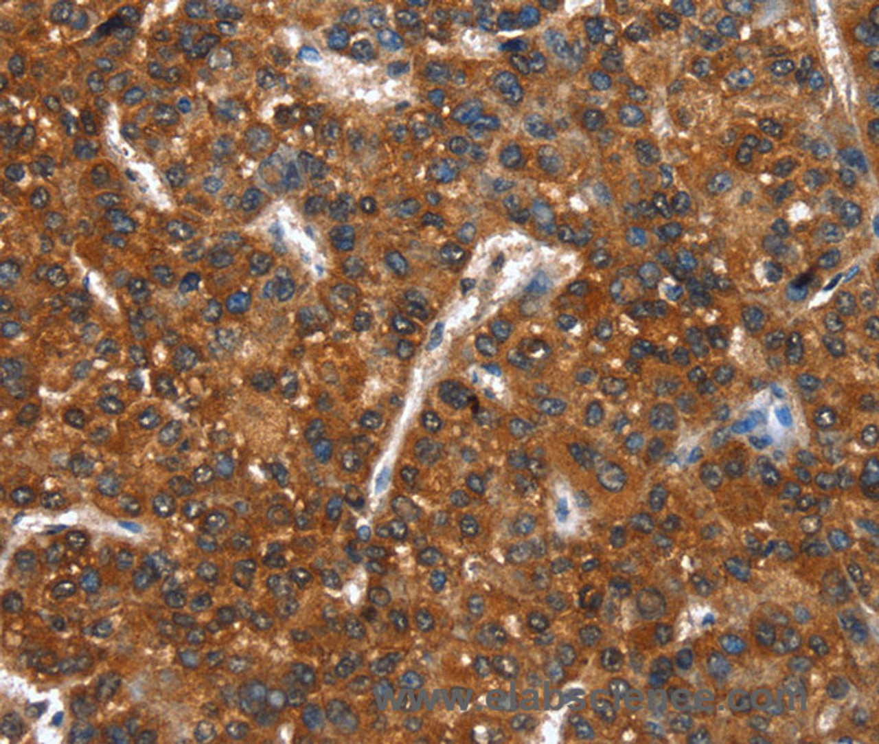 Immunohistochemistry of paraffin-embedded Human liver cancer using CTBP1 Polyclonal Antibody at dilution of 1:40