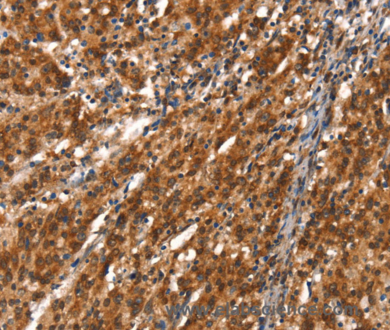 Immunohistochemistry of paraffin-embedded Human gasrtic cancer tissue using CYP2D6 Polyclonal Antibody at dilution 1:40