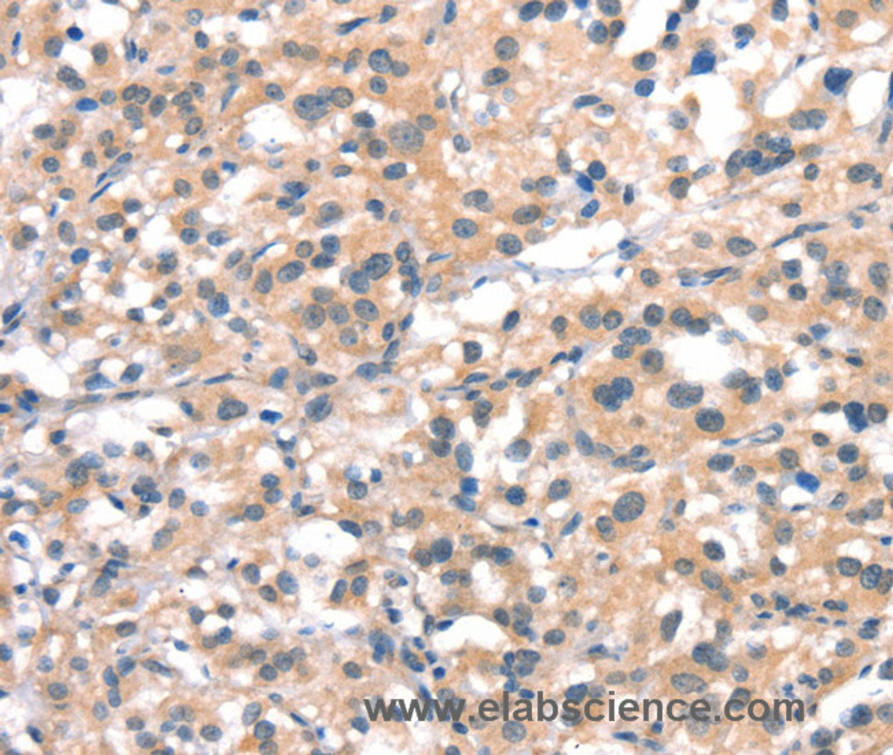 Immunohistochemistry of paraffin-embedded Human thyroid cancer tissue using CYP2D6 Polyclonal Antibody at dilution 1:40