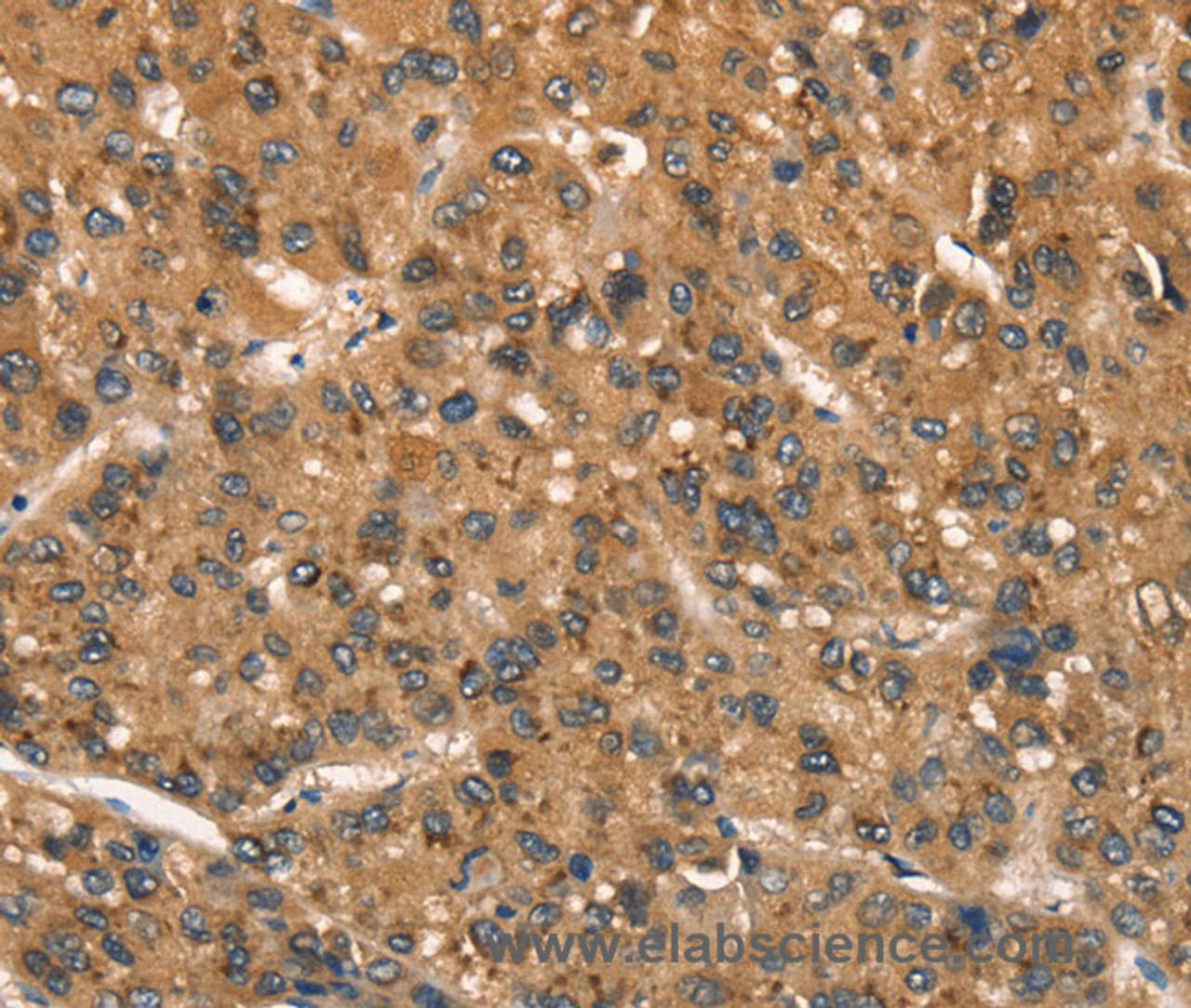 Immunohistochemistry of paraffin-embedded Human liver cancer tissue using CSTB Polyclonal Antibody at dilution 1:30