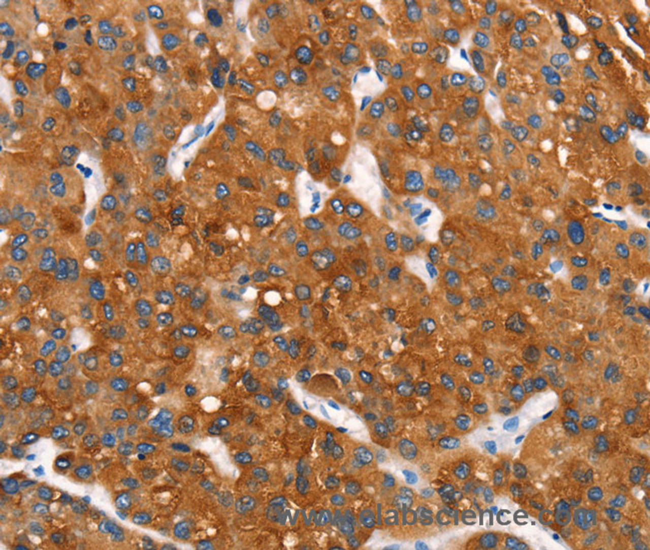 Immunohistochemistry of paraffin-embedded Human liver cancer tissue using Cytochrome b Polyclonal Antibody at dilution 1:30