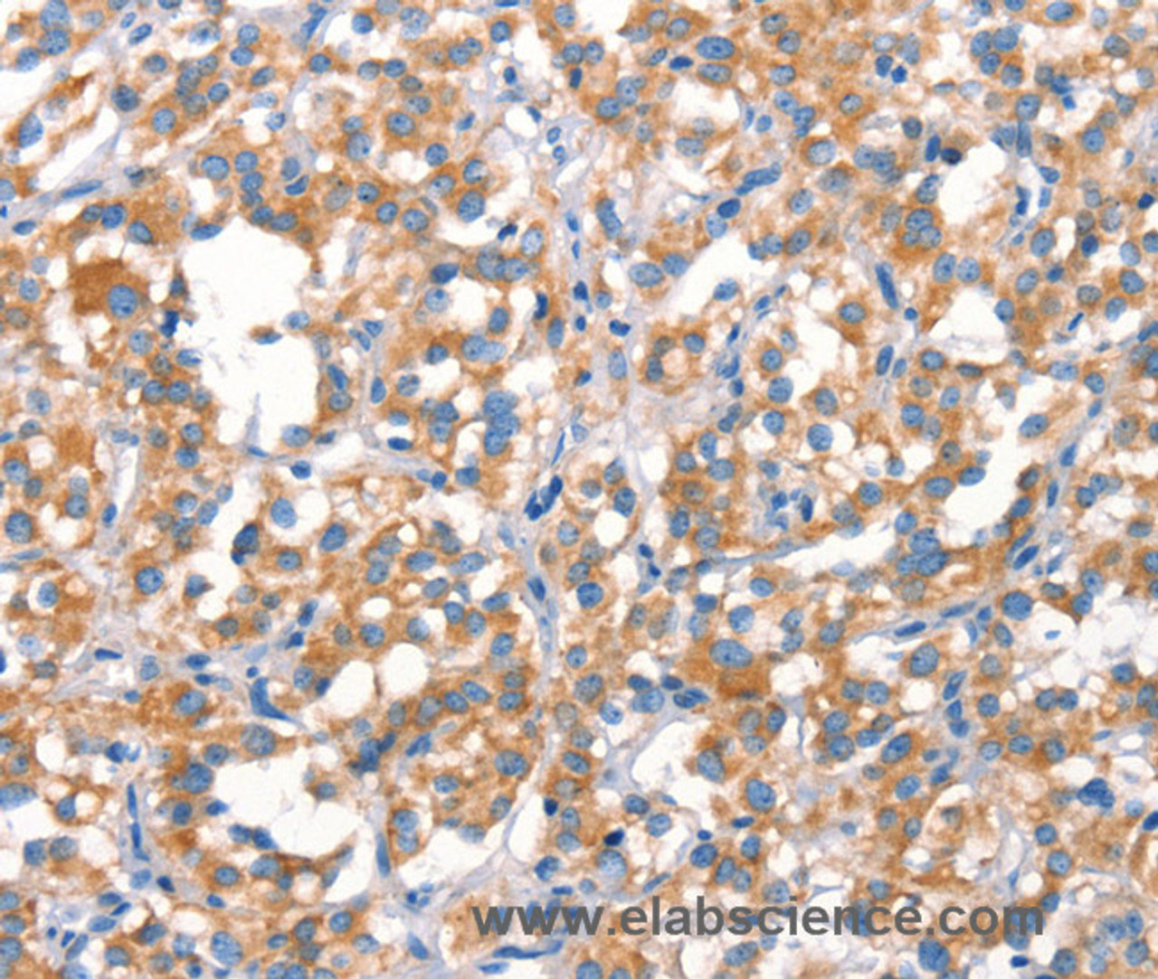 Immunohistochemistry of paraffin-embedded Human thyroid cancer tissue using Cytochrome b Polyclonal Antibody at dilution 1:30