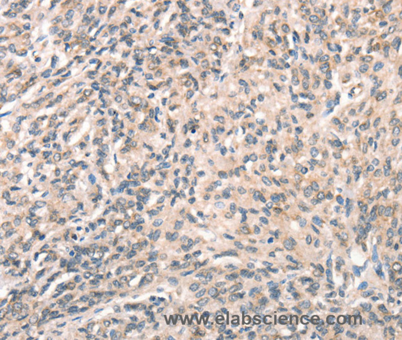 Immunohistochemistry of paraffin-embedded Human prostate cancer using DECR1 Polyclonal Antibody at dilution of 1:50